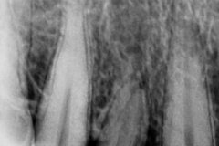 Root stump  x ray | Painless extrction | SmileMax Dental