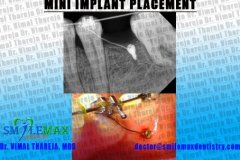 Advanced braces | Miniscrew assisted orthodontics | SmileMax Dental