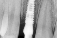 Dental Implants | Fixed teeth | SmileMax Dental