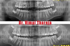 Advanced braces | Impacted teeth | SmileMax Dental