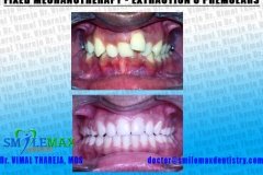 braces | Complex cases | SmileMax Dental