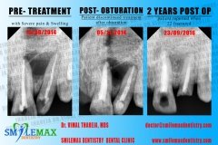 Dental pulp | painless root canal treatment | RCT | SmileMax Dental