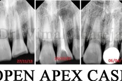 Dental pulp | painless root canal treatment | RCT | SmileMax Dental