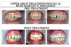 Removable braces | Simple spaces | SmileMax Dental