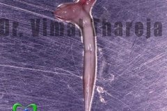 Dental pulp | painless root canal treatment | RCT | SmileMax Dental