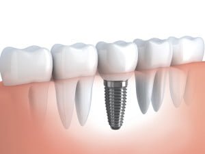 Dental Implants Delhi