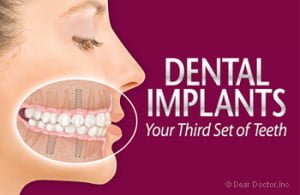 Dental Implants Delhi