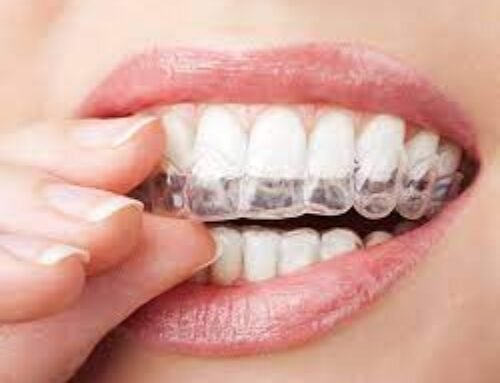 Unlocking the Secrets: The Cost of Braces Demystified for a Radiant Smile