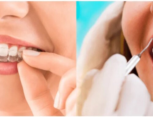 Say Goodbye to Metal Braces: Discover Invisalign Near You